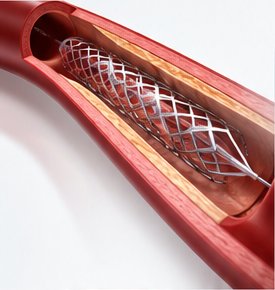 Stent in a coronary artery